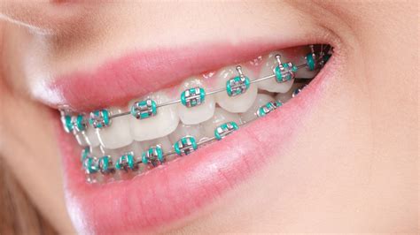 metal bracket orthodontic|pictures of traditional steel braces.